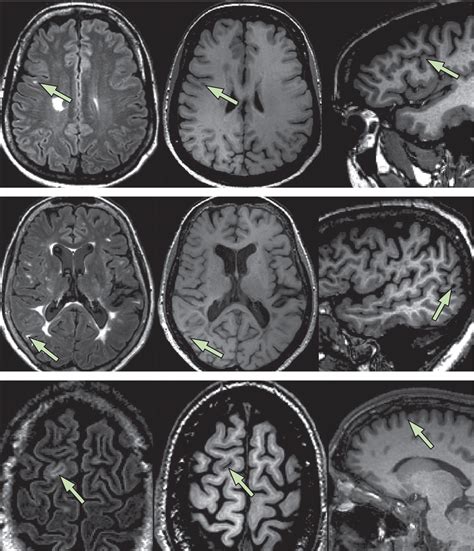MRI Criteria For The Diagnosis Of Multiple Sclerosis MAGNIMS Consensus Guidelines The Lancet