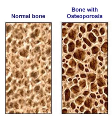 The Real Cause Of Osteoporosis Or Weak Bones Hubpages