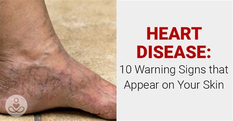 Heart Disease 10 Warning Signs That Appear On Your Skin Heart