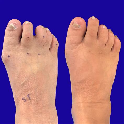 Before And After Bunion Surgery Photos Northwest Surgery Center