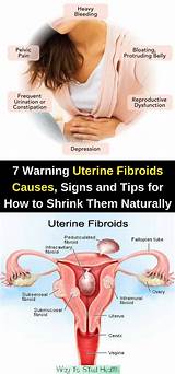 Images of Holistic Treatment For Fibroid Tumors