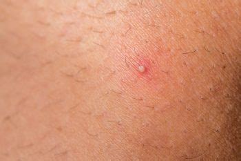 There are things you can do to treat and prevent them and in most cases you will not need to a see a gp for. Ingrown Hair Removal Daventry - Ingrown Hair Treatment ...