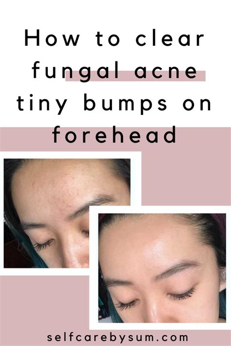 How To Clear Fungal Acne Tiny Bumps On Forehead Self Care By Sum Artofit