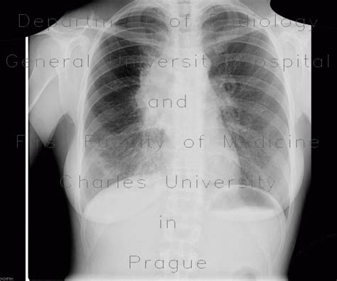 Radiology Case Mediastinal Lymphoma Chest Radiograph