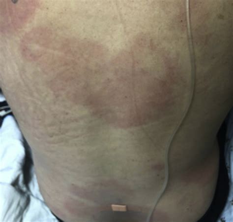 Multiple Erythema Migrans Rashes Characteristic Of Early Disseminated