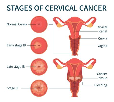 Stages Of Cervical Cancer White Infographic Scheme Vector Art