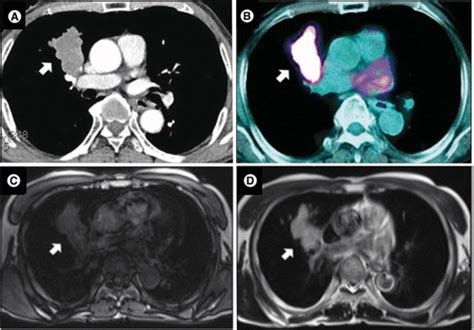 Pulmonary Metastatic Melanoma Current State Of Diagnostic Imaging And
