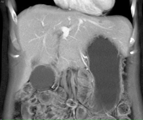Normal Small Bowel On Ct Enterography With Volumen Small Bowel Case