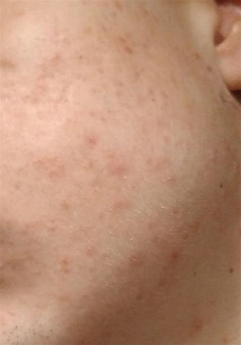 Acne Red Dots On Face Thats Not Pimples Skincareaddiction