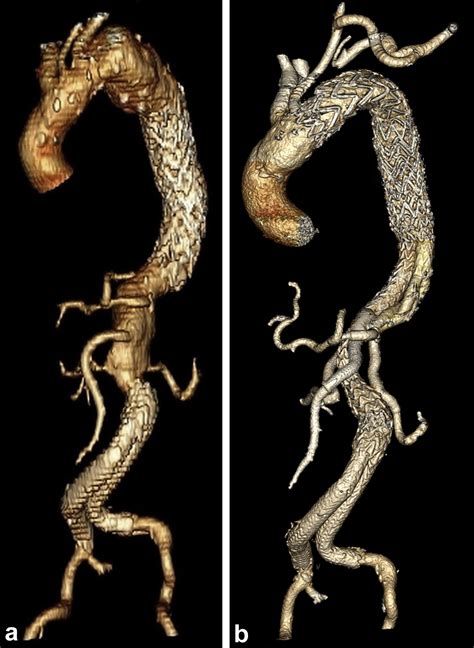 Use of the Octopus Technique for Endovascular Treatment of Complex