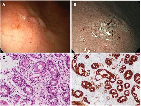 Gastric Adenocarcinoma Of Fundic Gland Type With Signet Ring Cell Carcinoma Component A Case