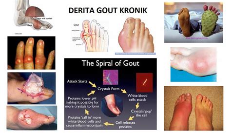 Bacaan 7.5 mg/dl adalah sedikit tinggi dari paras normal. .: Peringkat Gout dan Serangan Gout