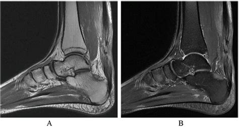 Mr Imaging Of The Achilles Tendon After Surgical Repair