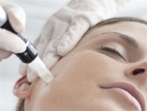 Collagen Stimulation Therapy Needling Treatment Now Available Rr Skin