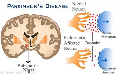 The scale was originally implemented in 1967 and it included stages zero to five, where zero is no signs of parkinson's and. Kinesiology & Sport Review: Parkinson's Disease: The Incurable Disease