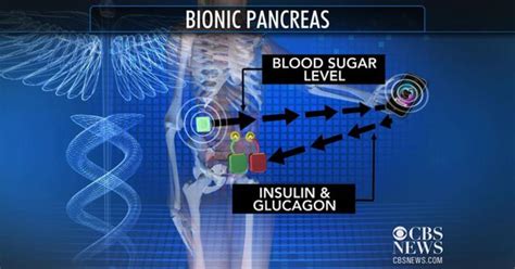 Bionic Pancreas Helps Manage Type 1 Diabetes Cbs News