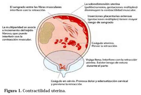 Ginecologia Y Obstetricia Hemorragia Postparto