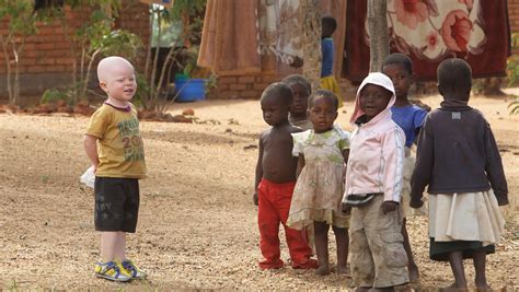 Albino People Increasingly Killed For Their Body Parts In Malawi