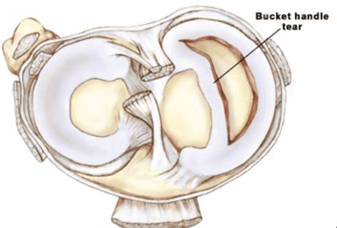 Bucket Handle Meniscus Tear Orthopedic Center For Sports Medicine Sports Medicine Physicians