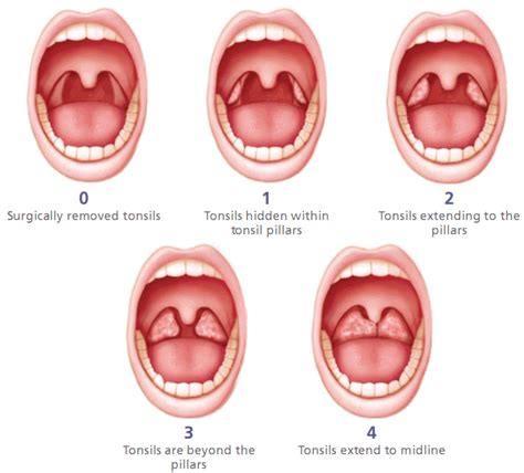 Tonsillectomy Mpenta