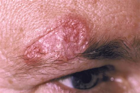 A 37 Year Old Male With An ‘itchy Lesion On His Face Journal Of