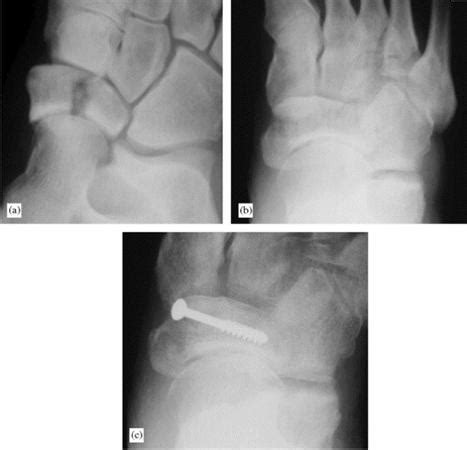 Tarsal Navicular Fractures - Foot & Ankle - Orthobullets