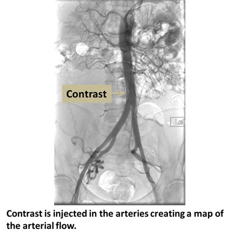 Angiography Interventional Radiology Ucla Health