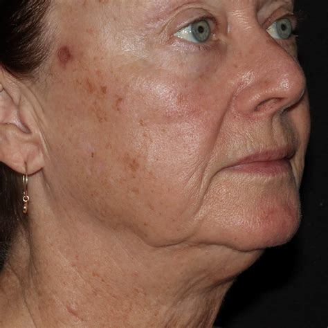 Rosacea Redness Birth Marks Port Wine Stains Dermatology Of The