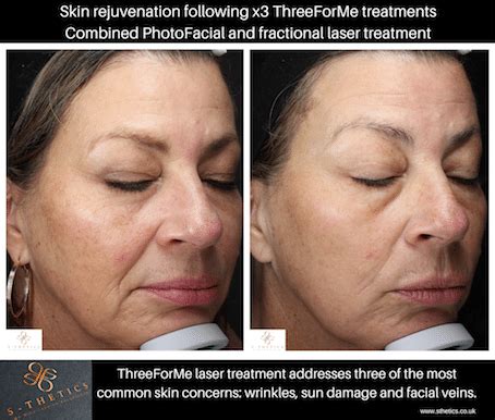 Laser skin rejuvenation treatments are best scheduled in the fall/winter when you are not in direct sun. Patient Success Story - Laser Treatment at S-Thetics ...
