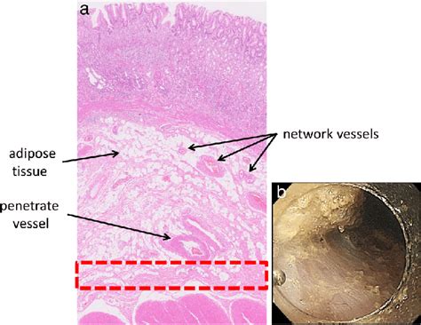 The Appropriate Depth For Dissection A The Deep Submucosal Layer