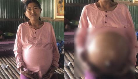 Medical Help Sought For Woman With 5 Year Pregnancy ⋆ Cambodia News English