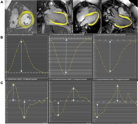 Frontiers | Left ventricular strain derived from cardiac magnetic