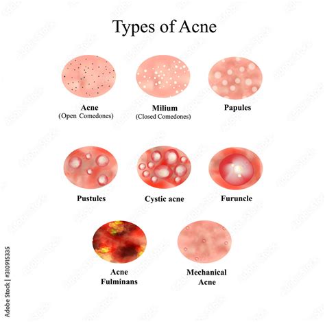 Types Of Acne Skin Inflammation Pimples Boils Whitehead Closed