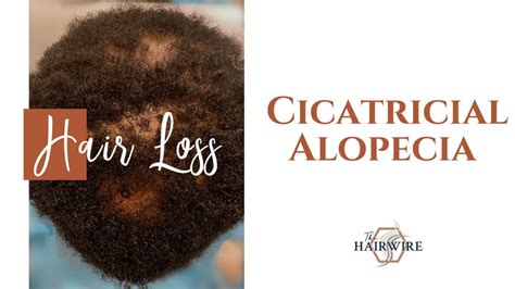 Cicatricial Alopecia The Hair Wire Gethairsmart