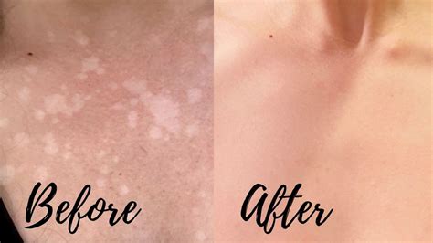 My At Home Tinea Versicolor Cure Fast Results Radiantly Nourished