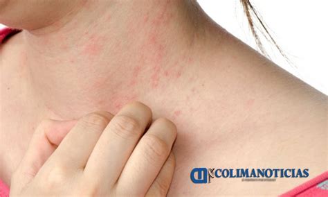 Dermatitis De Contacto La Alergia Más Común En Colima Salud Colima