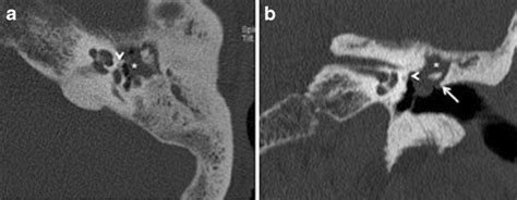 Axial A And Coronal B Hrct Images Of The Left Temporal Bone In An
