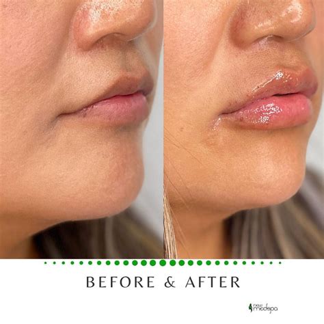 Lip Filler Before And After Med Spa Cosmetic Surgery Lip Fillers