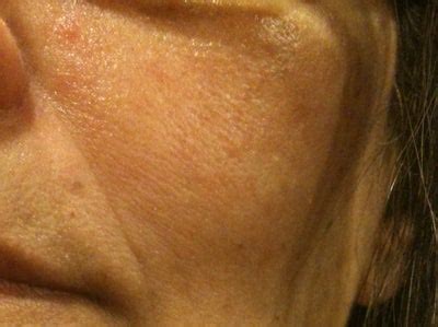 Once the pimple sets in, a safe way to try to decrease the inflammation quickly is to mix hydrocortisone 1 percent cream and a benzoyl. What Are The After Effects of Laser on Facial Skin? (photo ...