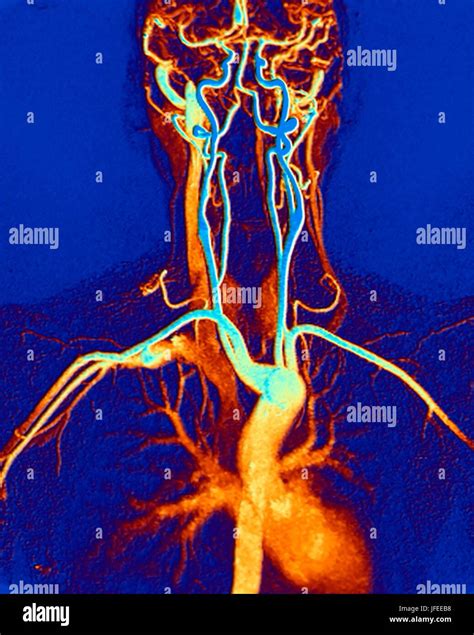 Chest Neck And Head Arteries Coloured Magnetic Resonance Angiography