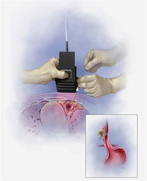 Corl Medical Media Ultrasound Guided Biopsy 2003