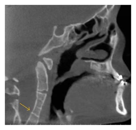 Carotid Artery Calcifications Are Seen Bilaterally On This Axial Image