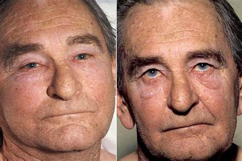 Reasons Why Your Face Looks Swollen Superior Vena Cava Syndrome Vena