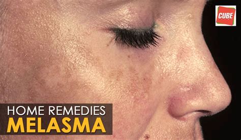 Melasma Treatment Cure Home Remedies Health Tips Video Dailymotion