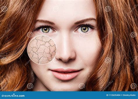 Zoom Circle Shows Facial Skin Before Moistening Stock Photo Image Of
