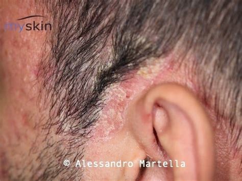 Dermatite Seborroica Conoscerla Per Curarla Myskin Dermatologi Online