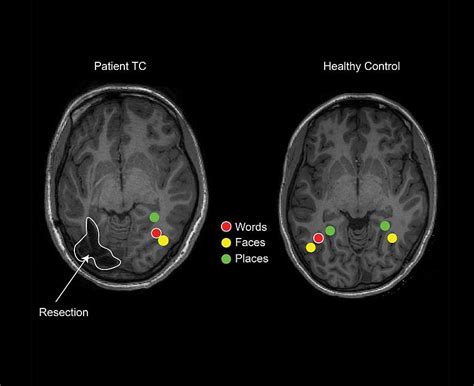 Childrens Brains Reorganize After Epilepsy Surgery To Retain Visual