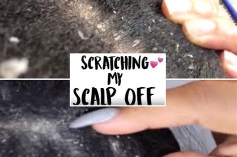 Move Over Dr Pimple Popper Dandruff Scraping Is The New Gross Trend