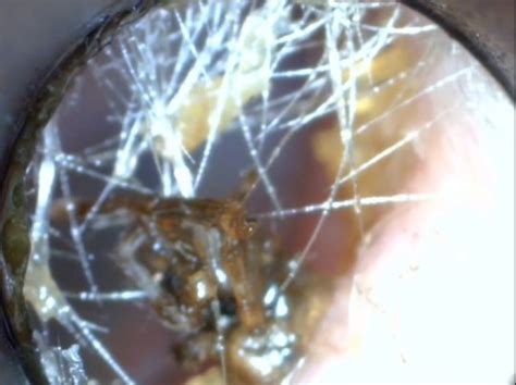Spider Removed From Boys Ear After It Crawled In On Camping Trip