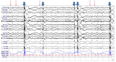 Electroencephalography Eeg Recorded At Three Hours After Hypoxic